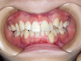 上顎前突 + 叢生（出っ歯、歯の凸凹） Before