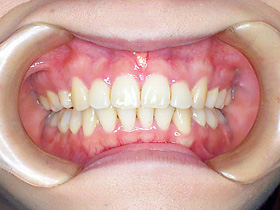 上顎前突 + 叢生（出っ歯、歯の凸凹） After