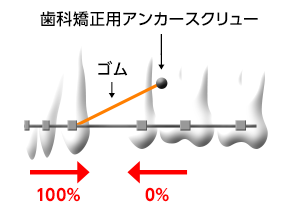 歯科矯正用アンカースクリューによる移動の利点